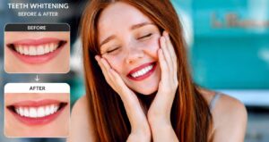 Are Good Whitening Strips for Sensitive Teeth Worth Trying?
