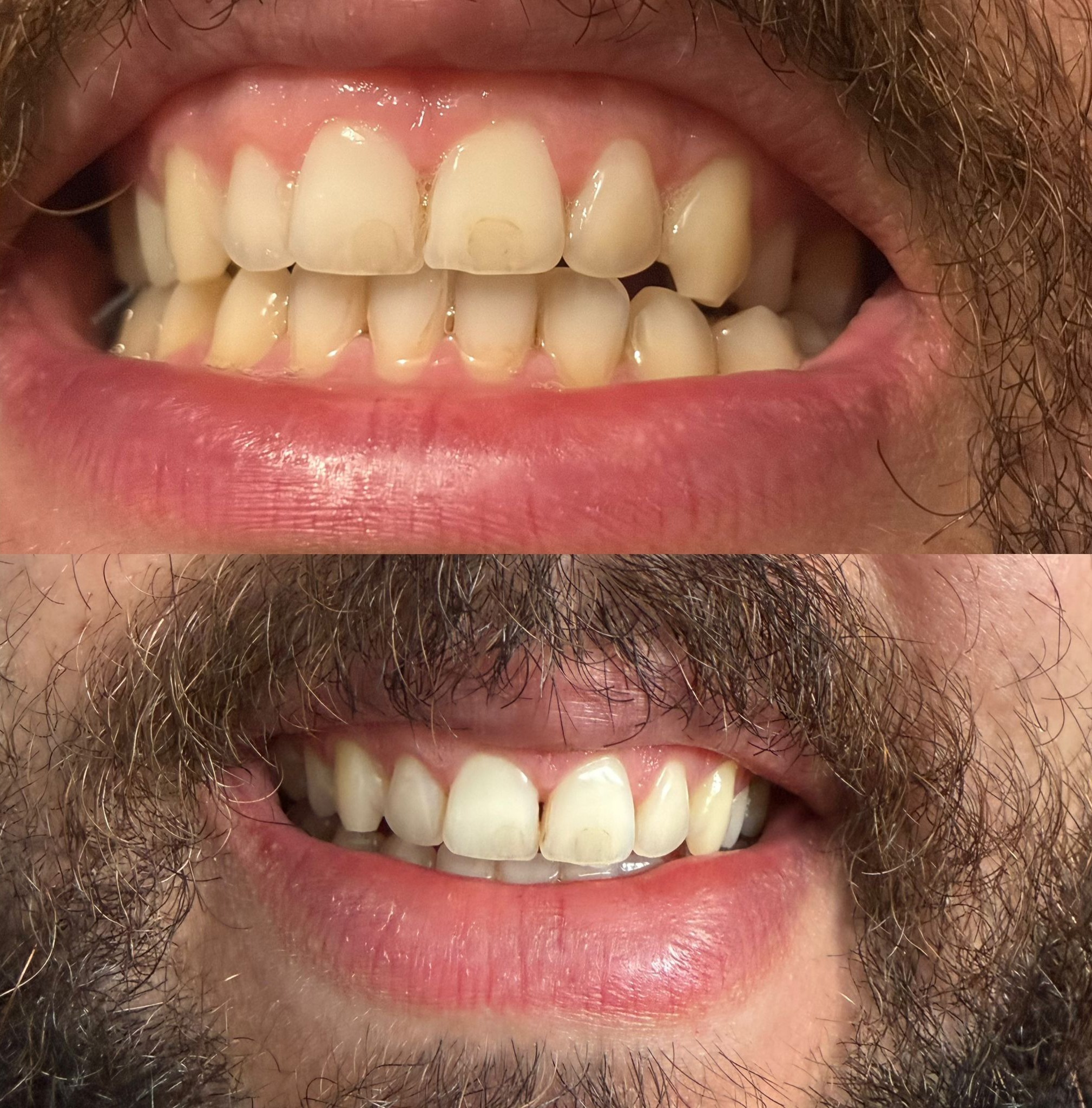 Before and after teeth whitening transformation